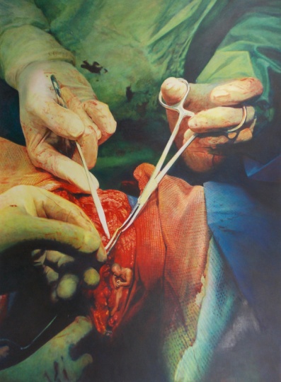 《一根肋骨》 220×160cm 布面油画 2008年,画中是手术实施取骨的过程何云昌将2004年行为作品《铸》也画于其中,他将自己困于水泥中24小时,这是他从水泥中挣扎出来的瞬间 《一根肋骨》 220×160cm 布面油画 2008年,画中是手术实施取骨的过程何云昌将2004年行为作品《铸》也画于其中,他将自己困于水泥中24小时,这是他从水泥中挣扎出来的瞬间